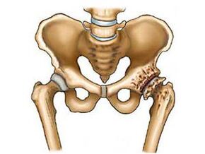 Was ist Arthrose des Hüftgelenks 