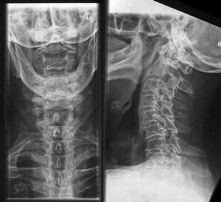 Röntgen der Halswirbelsäule - eine Methode zur Diagnose von Osteochondrose