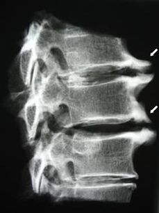 Osteophyten der Halswirbelsäule verursachen Nackenschmerzen