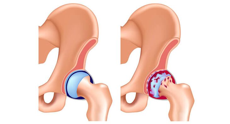 Gesundes und arthrotisches Hüftgelenk